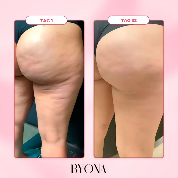 BYONA CelluPro Schröpfgerät